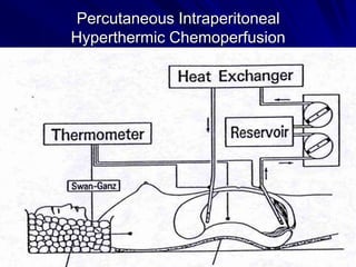 Percutaneous Intraperitoneal
Hyperthermic Chemoperfusion
-

edh ICHS
Shenzhen 2004

 