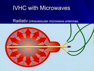 IVHC with Microwaves
Radiativ (intravesicular microwave antennae,

 