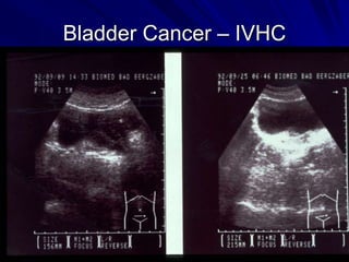 Bladder Cancer – IVHC

 