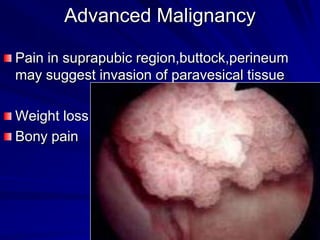 Advanced Malignancy
Pain in suprapubic region,buttock,perineum
may suggest invasion of paravesical tissue
Weight loss
Bony pain

 