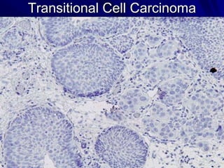 Transitional Cell Carcinoma

 