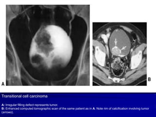 Transitional cell carcinoma
A: Irregular filling defect represents tumor.
B: Enhanced computed tomographic scan of the same patient as in A. Note rim of calcification involving tumor
(arrows).

 