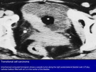 Transitional cell carcinoma
Unenhanced computed tomogram shows a sessile tumor along the right posterolateral bladder wall. A Foley
catheter balloon filled with air is in the center of the bladder.

 