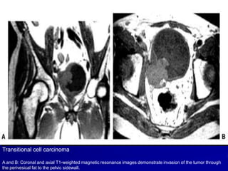 Transitional cell carcinoma
A and B: Coronal and axial T1-weighted magnetic resonance images demonstrate invasion of the tumor through
the perivesical fat to the pelvic sidewall.

 