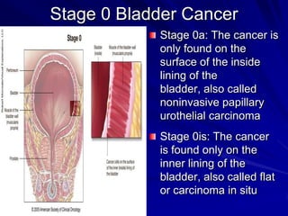 Stage 0 Bladder Cancer
Stage 0a: The cancer is
only found on the
surface of the inside
lining of the
bladder, also called
noninvasive papillary
urothelial carcinoma
Stage 0is: The cancer
is found only on the
inner lining of the
bladder, also called flat
or carcinoma in situ

 