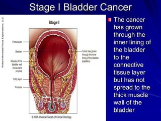Stage I Bladder Cancer
The cancer
has grown
through the
inner lining of
the bladder
to the
connective
tissue layer
but has not
spread to the
thick muscle
wall of the
bladder

 