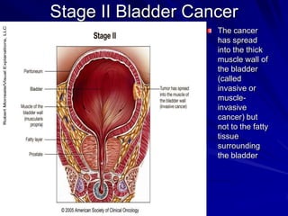 Stage II Bladder Cancer
The cancer
has spread
into the thick
muscle wall of
the bladder
(called
invasive or
muscleinvasive
cancer) but
not to the fatty
tissue
surrounding
the bladder

 