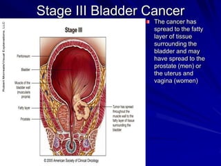 Stage III Bladder Cancer
The cancer has
spread to the fatty
layer of tissue
surrounding the
bladder and may
have spread to the
prostate (men) or
the uterus and
vagina (women)

 