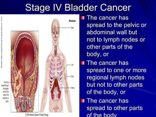 Stage IV Bladder Cancer
The cancer has
spread to the pelvic or
abdominal wall but
not to lymph nodes or
other parts of the
body, or
The cancer has
spread to one or more
regional lymph nodes
but not to other parts
of the body, or
The cancer has
spread to other parts

 