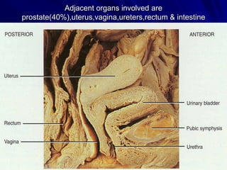 Adjacent organs involved are
prostate(40%),uterus,vagina,ureters,rectum & intestine

 