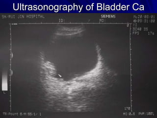 Ultrasonography of Bladder Ca

 