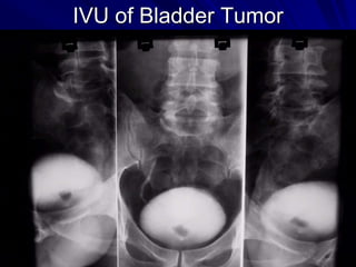 IVU of Bladder Tumor

 