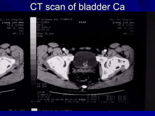 CT scan of bladder Ca

 