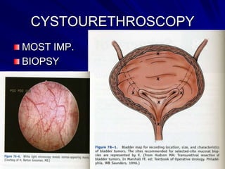 CYSTOURETHROSCOPY
MOST IMP.
BIOPSY

 