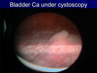 Bladder Ca under cystoscopy

 