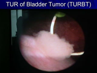 TUR of Bladder Tumor (TURBT)

 