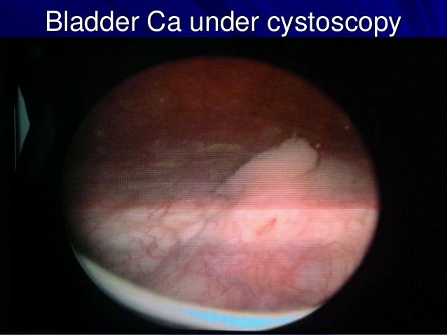 Bladder carcinoma