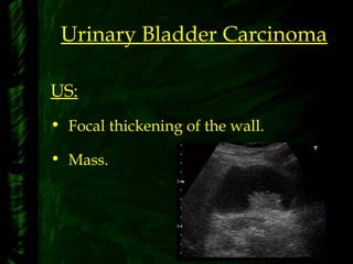Urinary Bladder Carcinoma
US:
• Focal thickening of the wall.
• Mass.
 