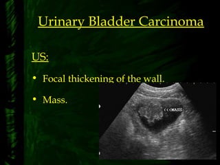Urinary Bladder Carcinoma
US:
• Focal thickening of the wall.
• Mass.
 