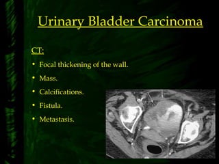Urinary Bladder Carcinoma
CT:
• Focal thickening of the wall.
• Mass.
• Calcifications.
• Fistula.
• Metastasis.
 