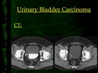 Urinary Bladder Carcinoma
CT:
 