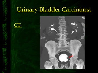Urinary Bladder Carcinoma
CT:
 