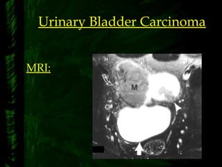 Urinary Bladder Carcinoma
MRI:
 