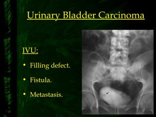 Urinary Bladder Carcinoma
IVU:
• Filling defect.
• Fistula.
• Metastasis.
 