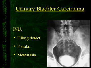 Urinary Bladder Carcinoma
IVU:
• Filling defect.
• Fistula.
• Metastasis.
 