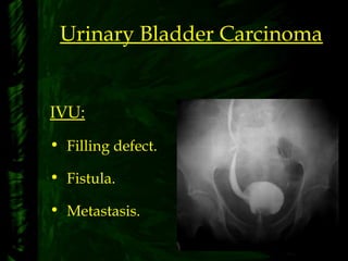 Urinary Bladder Carcinoma
IVU:
• Filling defect.
• Fistula.
• Metastasis.
 