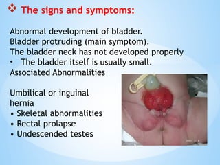 Bladder_Exstrop.pptxfewewfefewffffffffef | PPTX