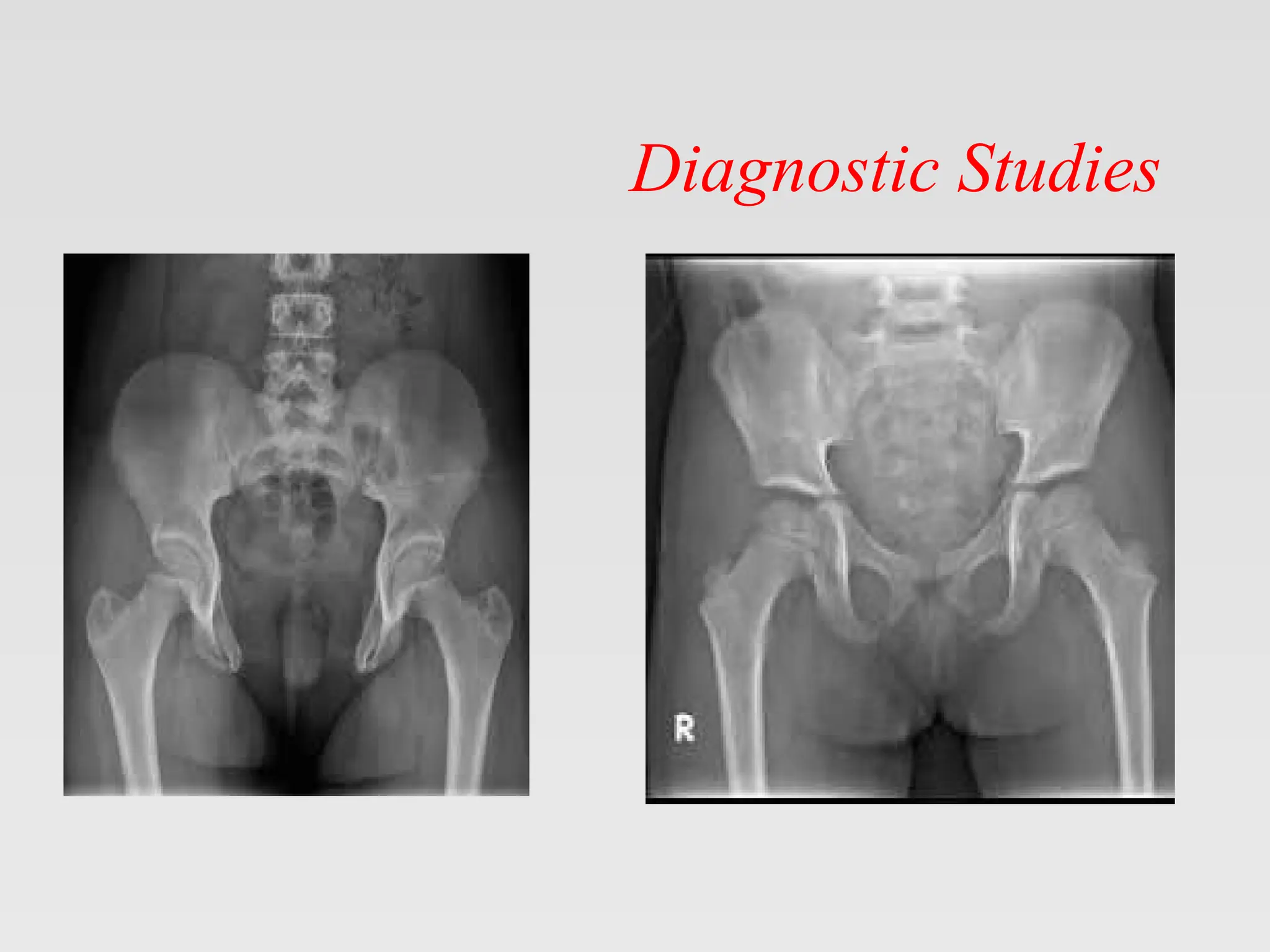 Exstrophy Bladder Exstrophy Epispadias Complex .pptx