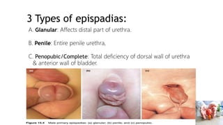 Bladder Extrophy and Epispadias Complex BEEC - Dr. ESIRU-2.pptx