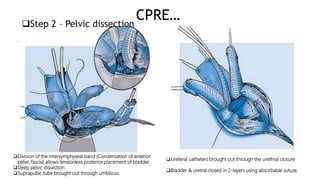 Bladder Extrophy and Epispadias Complex BEEC - Dr. ESIRU-2.pptx