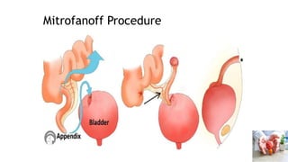 Bladder Extrophy and Epispadias Complex BEEC - Dr. ESIRU-2.pptx