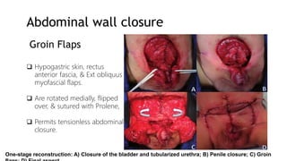 Bladder Extrophy and Epispadias Complex BEEC - Dr. ESIRU-2.pptx