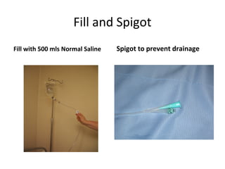 Fill and Spigot
Fill with 500 mls Normal Saline   Spigot to prevent drainage
 