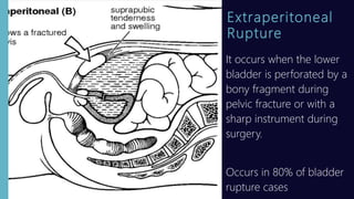 Extraperitoneal
Rupture
It occurs when the lower
bladder is perforated by a
bony fragment during
pelvic fracture or with a
sharp instrument during
surgery.
Occurs in 80% of bladder
rupture cases
 