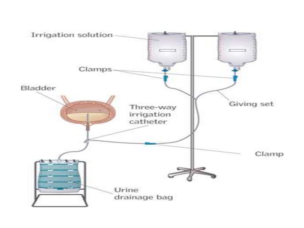 Bladder irrigation