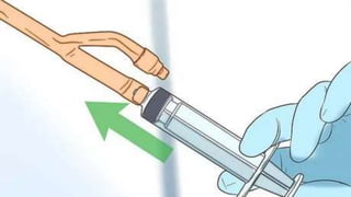 Bladder irrigation | PPTX