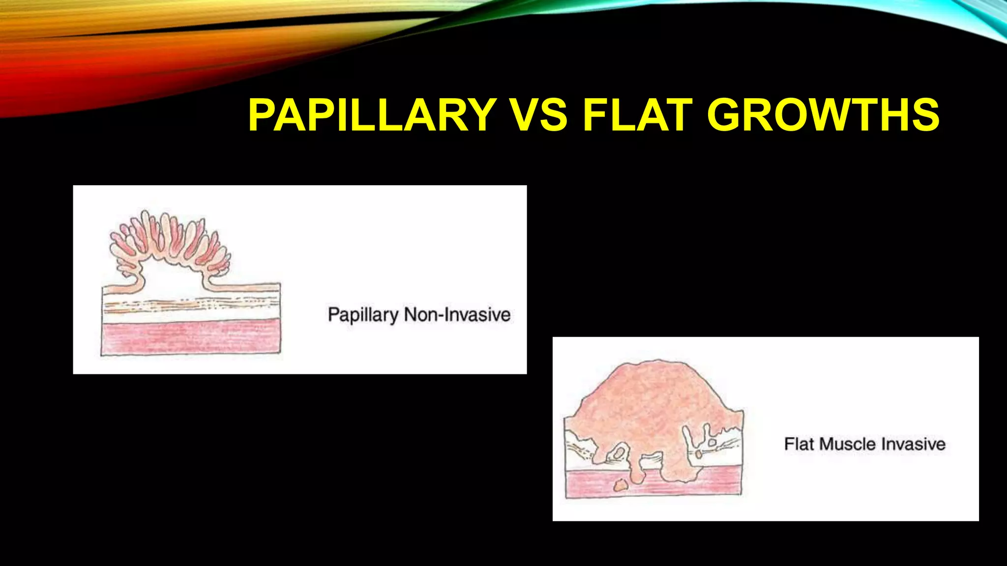 PAPILLARY VS FLAT GROWTHS
 
