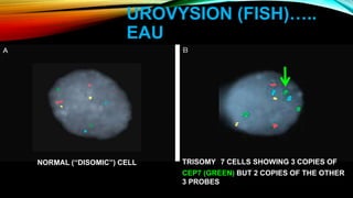 UROVYSION (FISH)…..
EAU
NORMAL (‘‘DISOMIC’’) CELL TRISOMY 7 CELLS SHOWING 3 COPIES OF
CEP7 (GREEN) BUT 2 COPIES OF THE OTHER
3 PROBES
 