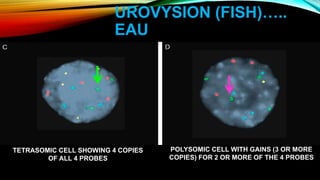 UROVYSION (FISH)…..
EAU
TETRASOMIC CELL SHOWING 4 COPIES
OF ALL 4 PROBES
POLYSOMIC CELL WITH GAINS (3 OR MORE
COPIES) FOR 2 OR MORE OF THE 4 PROBES
 