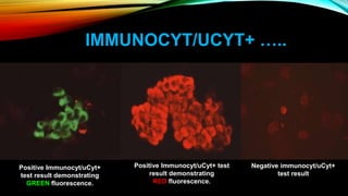 IMMUNOCYT/UCYT+ …..
Positive Immunocyt/uCyt+
test result demonstrating
GREEN fluorescence.
Negative immunocyt/uCyt+
test result
Positive Immunocyt/uCyt+ test
result demonstrating
RED fluorescence.
 