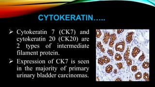 CYTOKERATIN…..
 Cytokeratin 7 (CK7) and
cytokeratin 20 (CK20) are
2 types of intermediate
filament protein.
 Expression of CK7 is seen
in the majority of primary
urinary bladder carcinomas.
 