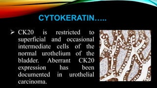 CYTOKERATIN…..
 CK20 is restricted to
superficial and occasional
intermediate cells of the
normal urothelium of the
bladder. Aberrant CK20
expression has been
documented in urothelial
carcinoma.
 