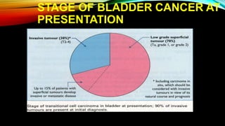 STAGE OF BLADDER CANCER AT
PRESENTATION
 