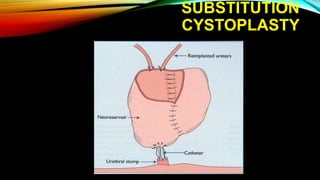 SUBSTITUTION
CYSTOPLASTY
 