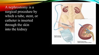 A nephrostomy is a
surgical procedure by
which a tube, stent, or
catheter is inserted
through the skin
into the kidney
 