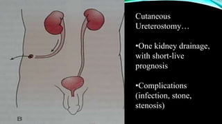 Cutaneous
Ureterostomy…
•One kidney drainage,
with short-live
prognosis
•Complications
(infection, stone,
stenosis)
 
